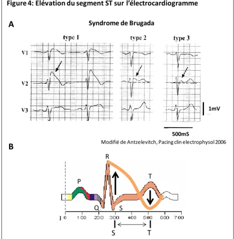 Figure 4: Elévation du segment ST sur l’électrocardiogramme