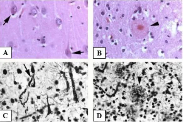 Figure  16:  Lésions  histologiques  caractéristiques  de  la  maladie  d’Alzheimer  mises en évidence par des techniques de colorations d’après Kövari et al