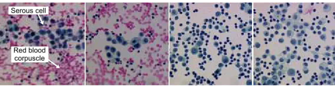 Figure 1: Four samples of microscopic images of serous effusions. ( Reproduced by courtesy of the Pathological Anatomy and Cytology Department of the Public Hospital Center of Cotentin.)