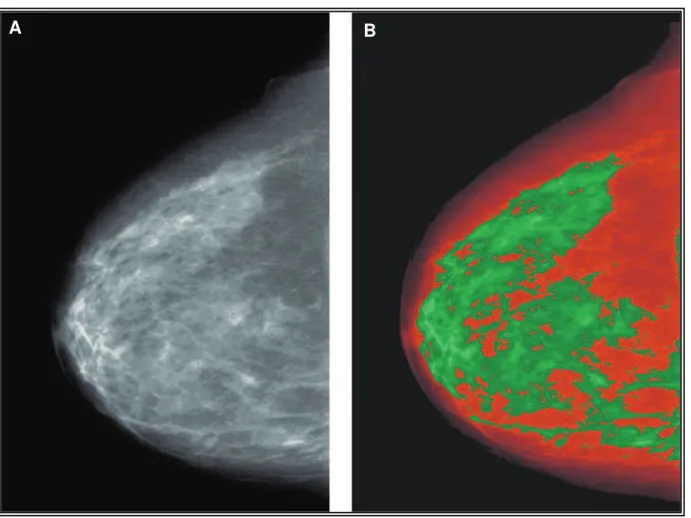Figure 5 : Image mammaire telle que visualisée à la mammographie (A) et par le programme Cumulus 