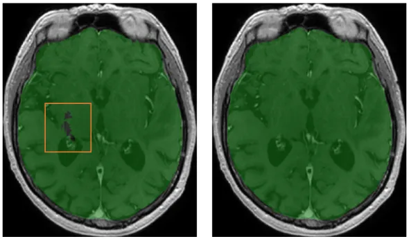 Figure 3: Example of ’holes’ in the original output segmentation (left image) on a test example