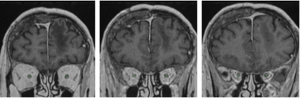 Figure 5: The centerlines of the optic nerves computed by our system on a test example (displayed on three different coronal slices)
