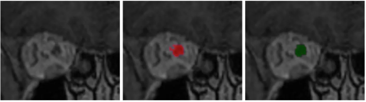 Figure 6: Use of mathematical morphology for reduction of false positives. Left: a coronal patch centered on an optic nerve