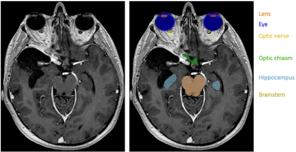 Figure 1: Segmentation of organs at risk in radiotherapy planning. Left: T1-weighted MRI acquired after injection of a gadolinium-based contrast agent