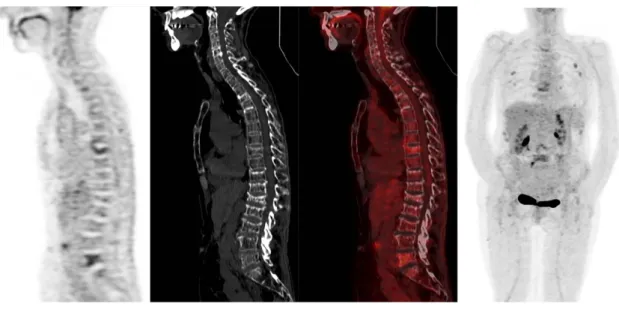 Figure 5. 62-year-old female with ISS1 kappa IgG Multiple Myeloma. Sagittal 18-FDG PET  images show a mild and diffuse bone marrow uptake of the spine assorted with focal uptakes  of  few  vertebral  bodies