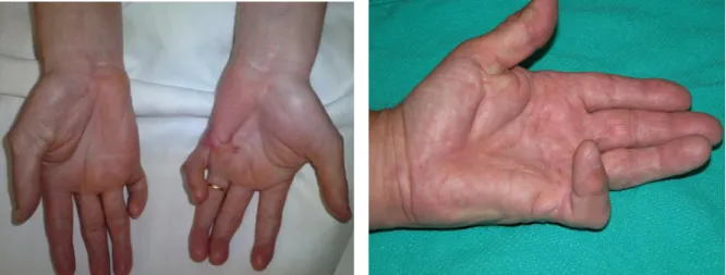 Figure 3. Clinical photograph showing the hands of two patients with advanced stage DD showing severe  deformity
