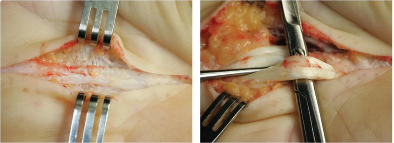 Figure 7. A. Exposure of Dupuytren’s cord in the palm of the hand. From Rozen et al. 2012