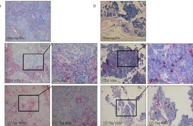 Figure  10:  TCL1+/+  mice  develop  a  CD5-positive  B  cell  lymphoma.  Representative  Giemsa  stain and immunohistochemical staining for CD5 and CD79a in spleen (a) and bone marrow (b)  from a leukemic TCL1 +/+  mouse