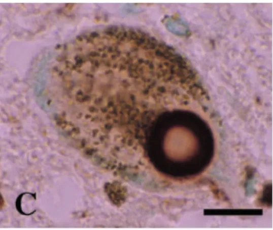 Abbildung 1-1: Lewy-Körperchen eines pigmentierten Neurons der substantia nigra eines Parkinson Patienten
