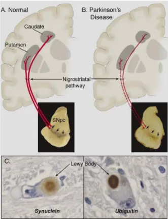 Abb. 1.1: In der oberen Bildreihe ist die nigrostriatale Nervenbahn (rot) einer gesunden Person (A) und  eines PD-Patienten (B) dargestellt