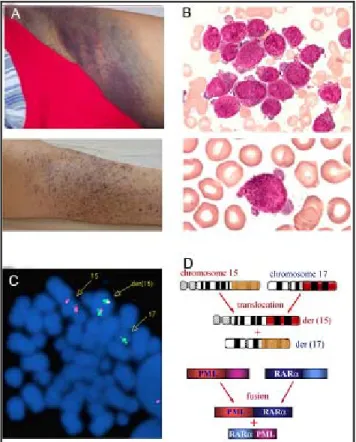 Abb. 1.1.6:  Die drei Merkmale von APL: (A) Patienten, die wegen eines erhöhten Fibrinogengehaltes im  Blut und wegen einer ausstreuenden intravaskulären Gerinnung eine schwerwiegende  Blutungstendenz aufweisen