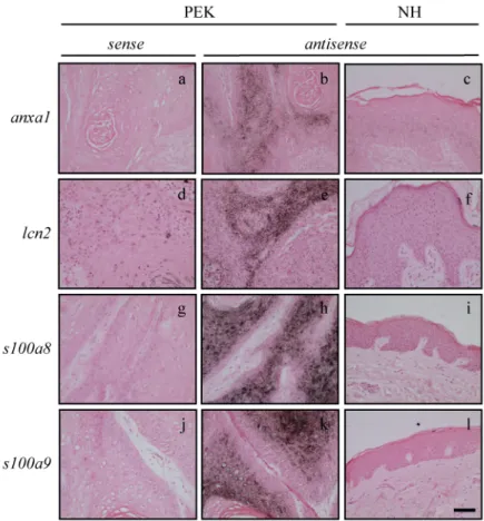 Abb. 7: Induzierte Expression von anxa1, lcn2, s100a8 und s100a9 in humanen Hauttumoren