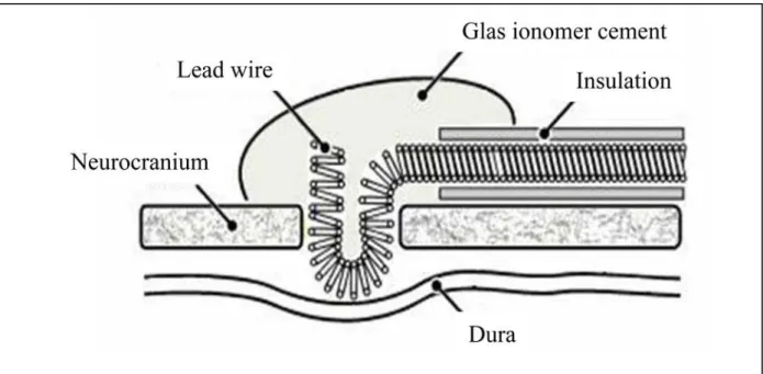 Abb. 13 Schematische Darstellung der platzierten Epiduralelektrode (M1) ohne Verletzung der Dura