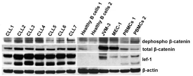 Figure 6: LEF-1 and β-catenin expression in CLL, cell lines and healthy B cells. Total  protein  extracts  from  primary  B-CLL  (n=7),  healthy  CD  19+  B  cells  (n=2),  healthy  PBMCs  (n=2),  and  B-CLL  cell  lines  were  probed  for  LEF-1,  total  