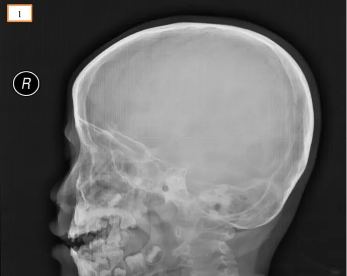 Figure 1: Radiograph of the skull showed faint pencil shadow over the left nasal cavity projecting to- to-wards the anterior skull base
