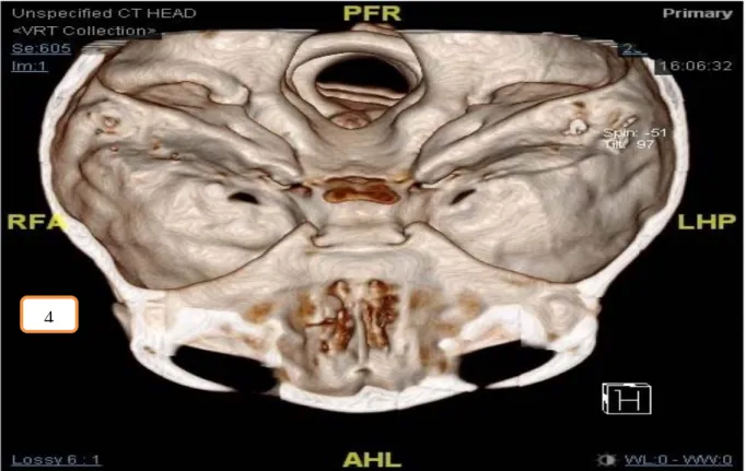 Figure 4: Three-dimensional (3D) images reconstructed from the fine cut CT scan of the brain, skull  base and paranasal sinuses showed right cribriform plate fracture
