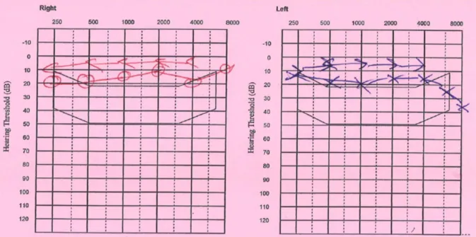 Figure 1: Pure-tone audiometry of mild hearing loss at high frequency on the left compared to the  normal hearing threshold on the right 