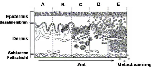 Abbildung 2.3:  A Melanozytische Hyperplasie B Junktionsnävus C  Dysplastischer Nävus mit  abnormalen architektonischen und zytologischen Merkmalen D Frühes Melanom in der radialen  Wachstumsphase E Fortgeschrittenes Melanom in der vertikale Wachstumsphase