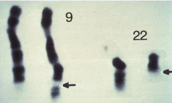 Figure 4: The unusual short Philadelphia chromosome was discovered in CML patients in 1960 