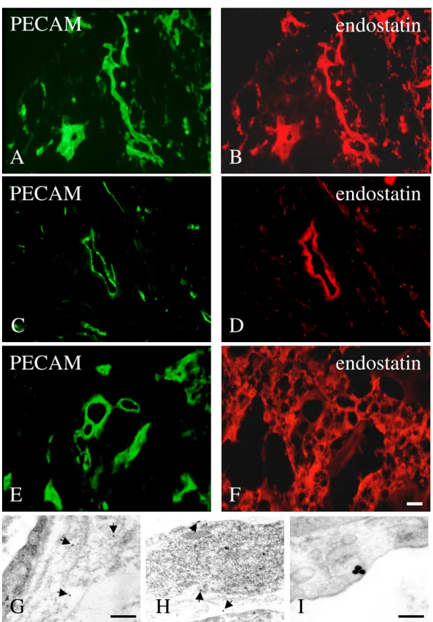 Figure  1:  (A,  C,  F)  Immunohistochemical  detection  of  endothelial  cells  and  vessels  in  bladder,  prostate  and  kidney tumour with an anti-human-PECAM-1 antibody