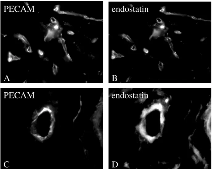 Figure 2: A-D: Endostatin binding to PECAM-positive vessels of prostatic hyperplasia. A and C  show an immunohistochemical staining with PECAM-1 to marks endothelial cells and vessels