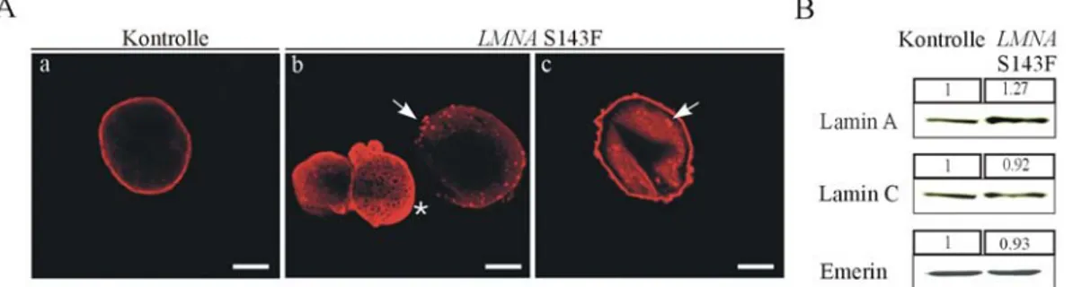 Abbildung 3.4.: LMNA S143F Fibroblasten weisen Veränderungen in der Lamin A/C  Lokalisation, nicht aber im Expressionsniveau auf