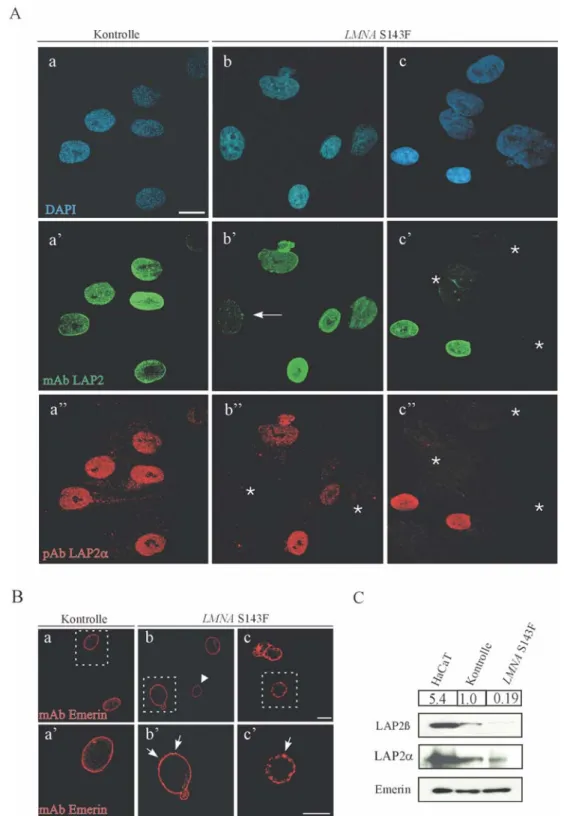 Abbildung 3.5.: Lokalisation und Expression der Proteine der LEM-Domäne-Familie. (A)  Anormale Lokalisation der LAP2-Isoformen in LMNA S143F Fibroblasten