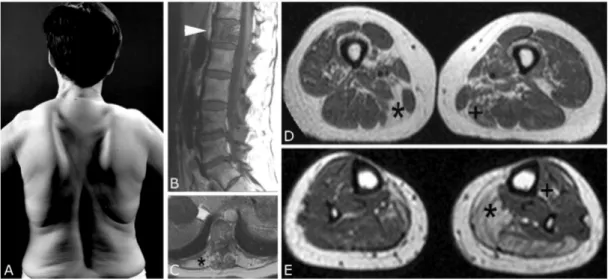 Fig. 2. Clinical and MRI findings in Patient III. 