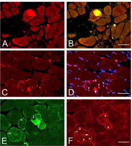 Fig. 4. Indirect immunofluorescence analysis of IBMPFD muscle from Patient II.