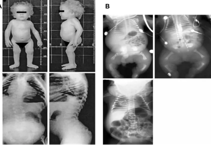 Fig 1.6 Phenotype of SEDC patients. (A)  Disproportionate short stature with short trunk, enlarged joints, high  forehead, frontal bossing, pectus carinatum deformity and radiological findings of anteroposterior and lateral spine  radiographs shows: thorac
