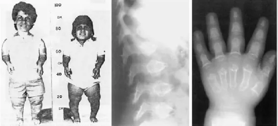 Abb. I 1:   Erscheinungsbild und Röntgenaufnahmen von PSACH Patienten