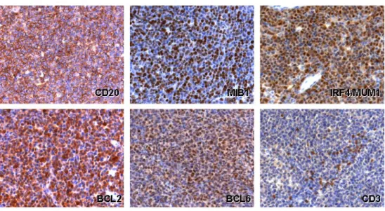 Abbildung 4: Immunhistologische Färbung von PCNSL. CD20: Cluster-Differenzierungsantigen, das  von B-Zellen aller Entwicklungsstadien exprimiert wird, außer von Vorläufer B-Zellen und Plasmazellen; 