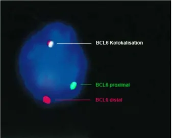 Abbildung 5: Interphase Fluoreszenz-in-situ-Hybridisierung eines PCNSL Zellkerns mit BCL6  Markern