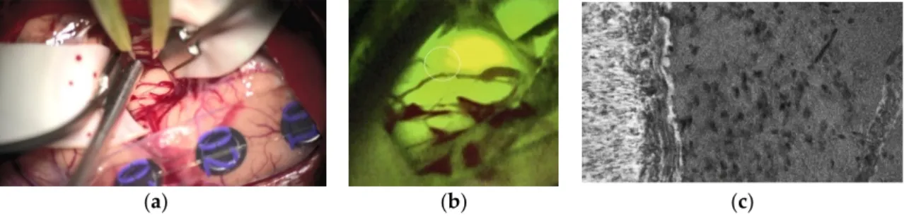 Figure 3. Lung cancer brain metastases (BM) of the right pre-motor cortex under white light (a), under YELLOW 560 nm  illumination (b), and the brain-tumor-interface with CLE (c)