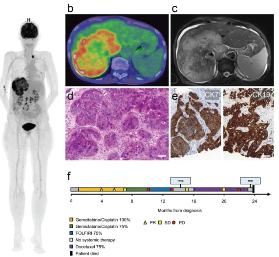 Figure 1. Imaging, histology and clinical course. (a) Three-dimensional positron emission tomography–computed to- to-mography reconstruction showing the large primary tumor mass in the right liver lobe and a left supraclavicular nodal metastasis