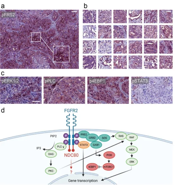 Figure 3. Evaluation of downstream effector proteins. (a) pFRS2 immunostaining of the nodal metastasis showing strong  membranous positivity