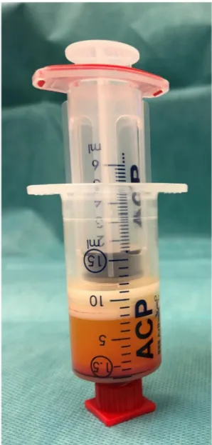 Figure 2. Emulsified, homogenized fat graft with oily phase and cell pellet at the bottom.