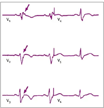 Abbildung 1-1. Darstellung eines Epsilon-Potentials im EKG.
