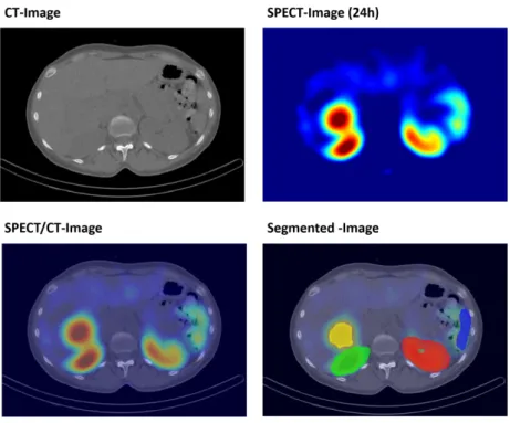 Figure 6.1: CT-image, SPECT-image and hyprid SPECT/CT-image as shown in ITK-snap. In the right bottom corner the segmentation of the right and left kidney, the spleen and a liver tumor can be seen.