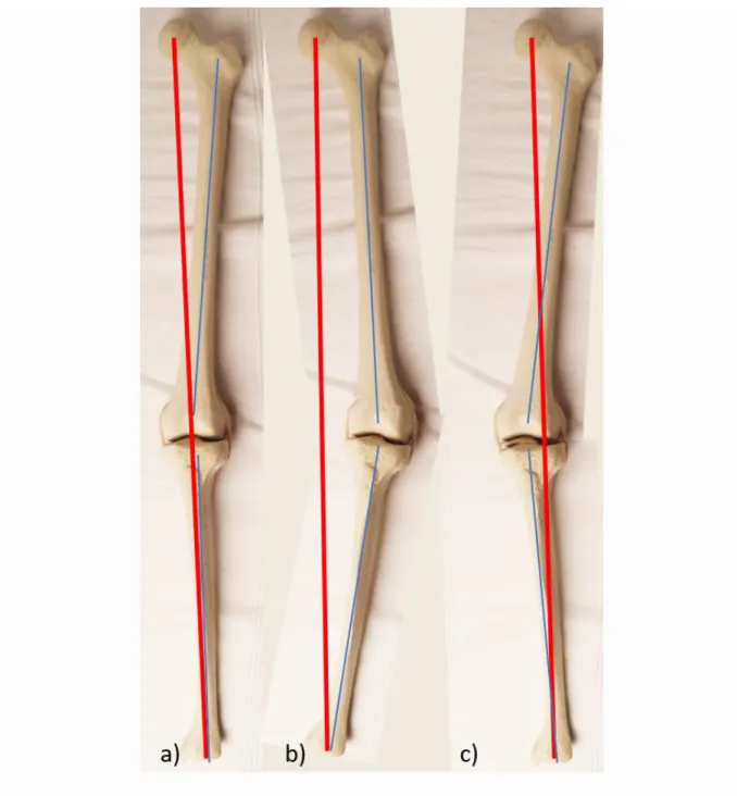 Abbildung 3: Darstellung der Beinachsen: physiologische Achse (a), varische (b) und  valgische Beinachse (c)