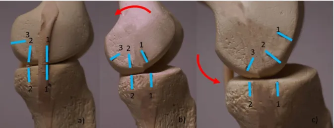 Abbildung 6: Kombinierte Roll-/Gleibewegung: a) Extension: zentraler Kontakt des Femurs  auf der Tibia (Femur 1 auf Tibia 1); b) frühe Beugung nach posterior