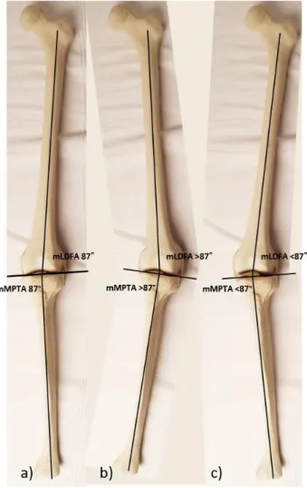 Abbildung 11: Darstellung der physiologischen Beinachse (a), Varus- (b) und Valgusachsen  (c) mit Darstellung des mechanischen lateralen distalen Femurwinkels (mLDFA, Normwert  87° ± 3°) und des mechanischen medialen proximalen Tibiawinkels (mMPTA, Normwer
