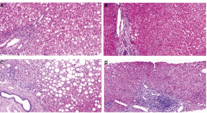 FIg. 2. Liver-biopsy hematoxylin and eosin staining. (A) Donor before DAA therapy with chronic, mostly portal, but discrete interface  hepatitis with a severe steatosis hepatis and mild fibrosis (1-2 Ishak score)