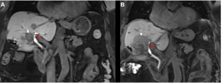 Figure  1  An  80-year-old  woman  with  a  centrally  located  HCC.  (A)  Coronal  contrast-enhanced  T1  vibe  3d  fat-suppressed  magnetic  resonance  imaging,  conducted  preinterventionally during the hepatobiliary phase, shows a centrally located HCC
