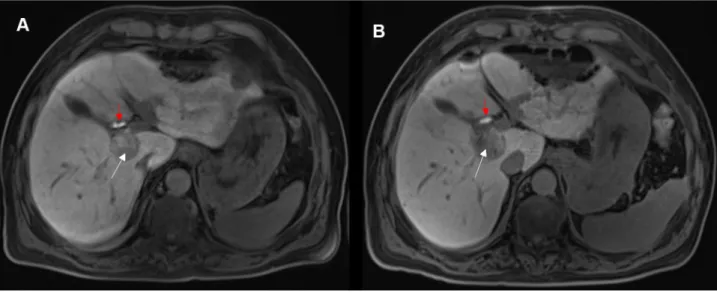Figure 2 A 67-year-old man with a centrally located HCC. (A) Axial contrast-enhanced T1 vibe 3d fat-suppressed magnetic resonance imaging, conducted preinterven- preinterven-tionally during the hepatobiliary phase, shows a centrally located HCC (white arro