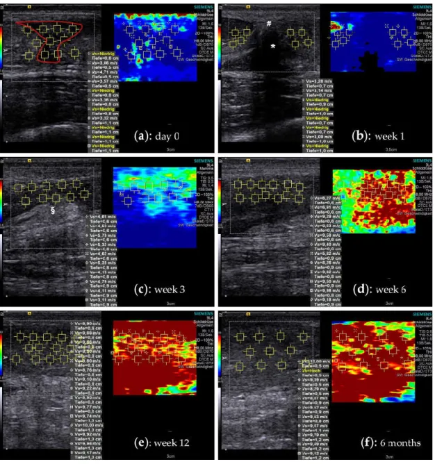 Figure 1. Shear wave elastography images during the course of tendon healing. A split screen view  with a B-mode ultrasound image on the left side allows choosing a particular ROI (yellow squares),  where the SWV is measured