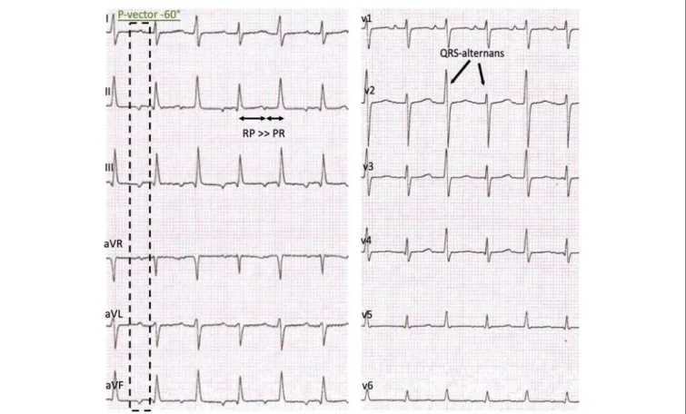 FIGURE 1 | Initial presentation: 12-lead-ECG with a regular sustained small QRS-Complex tachycardia, P-vector −60 ◦ , a delay of the atrioventricular conduction, RP &gt; PR and a QRS-complex amplitude alternans.