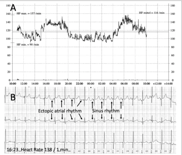 FIGURE 3 | Holter recording (follow up). (A) 24 h Heart rate recording showing a physiologic diurnal heart rate spectrum (heart rate maximum 157 beats/min, minimum 90 beats/min, mean 116 beats/min)