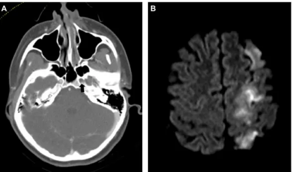 Figure 1. Dissection of the left internal carotid artery (ICA) with severe neurologic sequelae