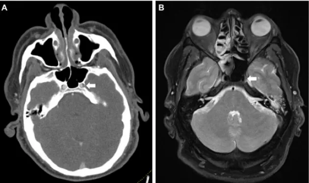 Figure 2. False-positive CT-A raising suspicion for an intramural hematoma of the left internal carotid  artery (ICA) in its petrosal segment